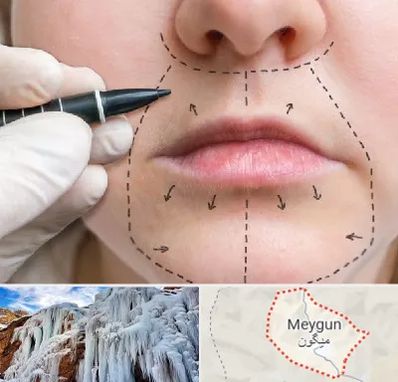 عمل سانترال لب در میگون