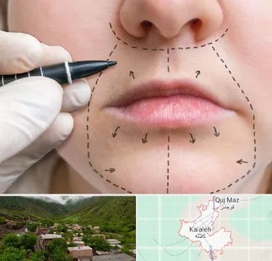 عمل سانترال لب در کلاله