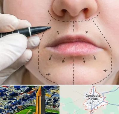 عمل سانترال لب در گنبد کاووس