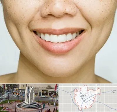 عمل چال گونه در زابل