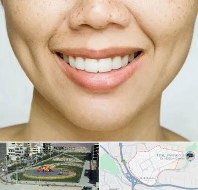 عمل چال گونه در مرزداران تبریز