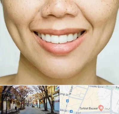 عمل چال گونه در تربیت تبریز