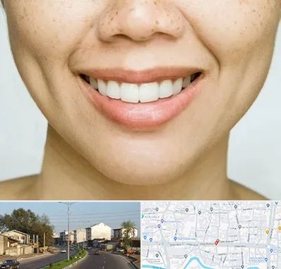 عمل چال گونه در ضیابری رشت