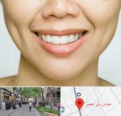 عمل چال گونه در ولیعصر شهریار