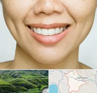 عمل چال گونه در گچساران