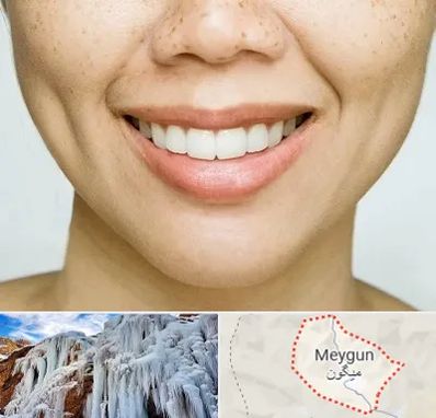عمل چال گونه در میگون