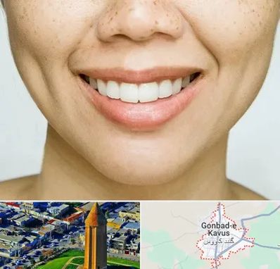عمل چال گونه در گنبد کاووس