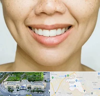 عمل چال گونه در نسیم شهر