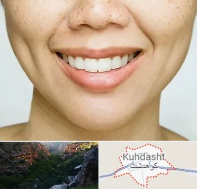 عمل چال گونه در کوهدشت