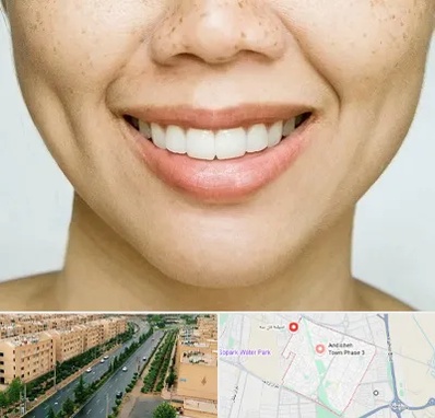 عمل چال گونه در فاز سه اندیشه