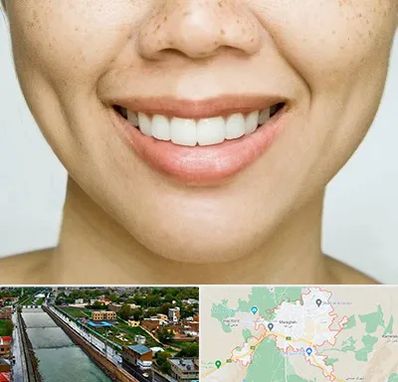 عمل چال گونه در مراغه