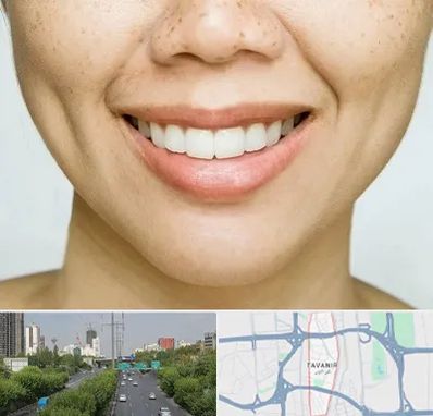 عمل چال گونه در توانیر
