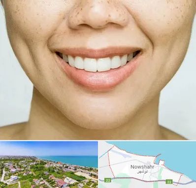 عمل چال گونه در نوشهر