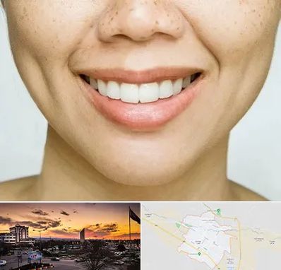 عمل چال گونه در قوچان