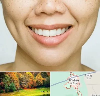 عمل چال گونه در کردکوی