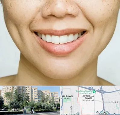 عمل چال گونه در آپادانا