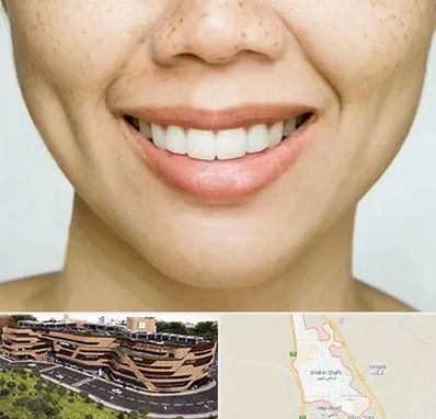 عمل چال گونه در شاهین شهر