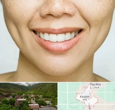 عمل چال گونه در کلاله