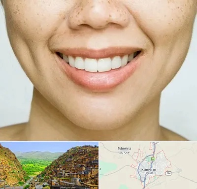 عمل چال گونه در کامیاران