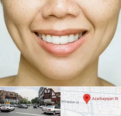 عمل چال گونه در خیابان آذربایجان