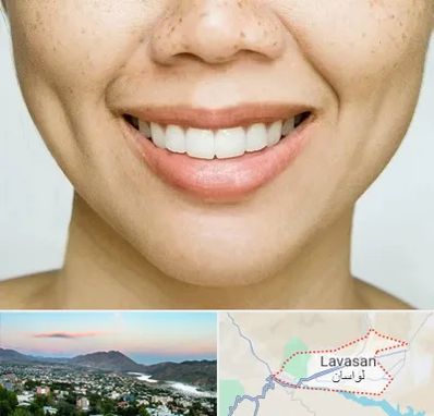 عمل چال گونه در لواسان