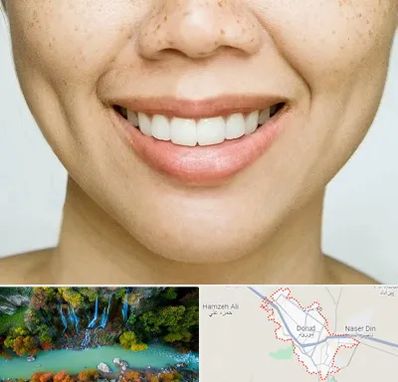 عمل چال گونه در دورود