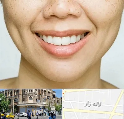 عمل چال گونه در لاله زار