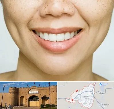 عمل چال گونه در ایرانشهر