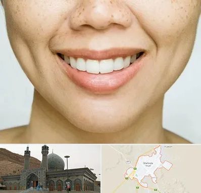 عمل چال گونه در شهرضا