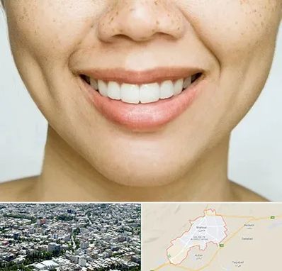 عمل چال گونه در شاهرود