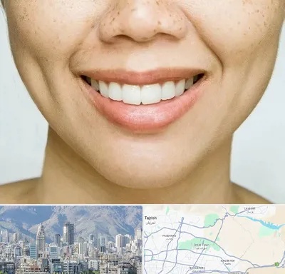 عمل چال گونه در شمال شرق تهران