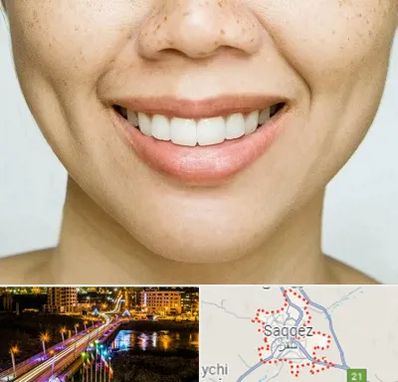 عمل چال گونه در سقز