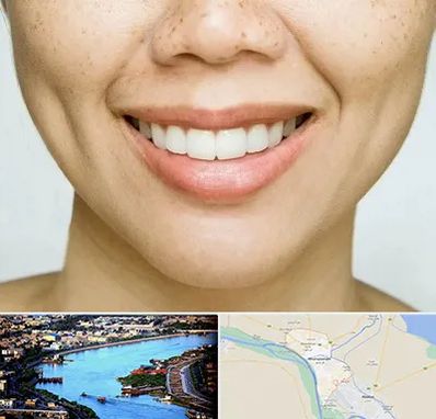 عمل چال گونه در خرمشهر