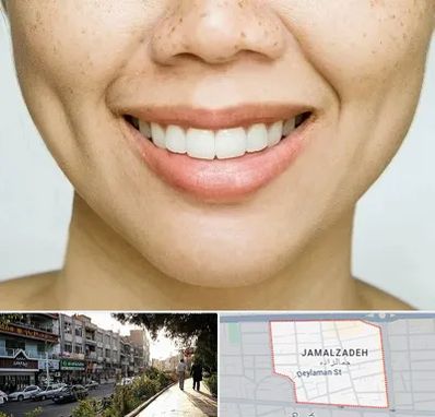 عمل چال گونه در خیابان جمالزاده