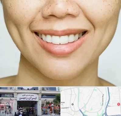 عمل چال گونه در ایران زمین