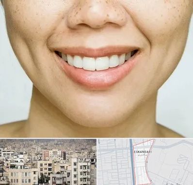 عمل چال گونه در اسکندری