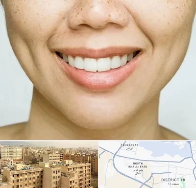 عمل چال گونه در جنوب غرب تهران