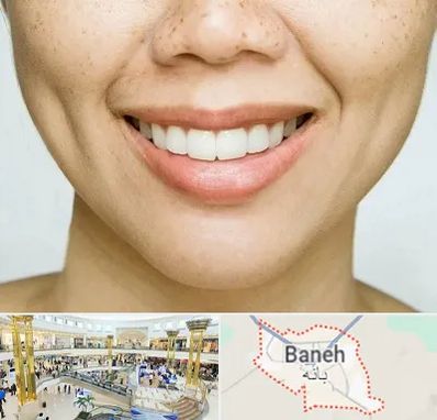 عمل چال گونه در بانه