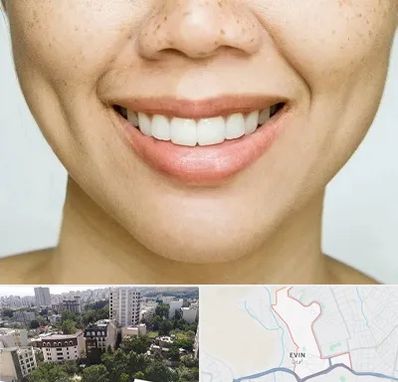 عمل چال گونه در اوین