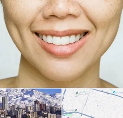 عمل چال گونه در ازگل