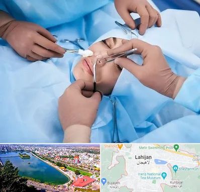 عمل بینی فانتزی در لاهیجان