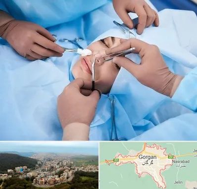 عمل بینی فانتزی در گرگان