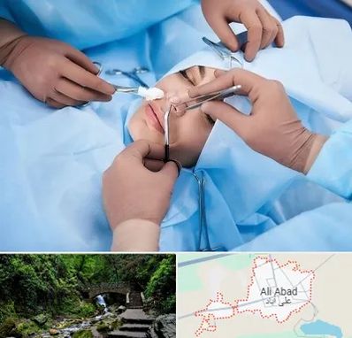 عمل بینی فانتزی در علی آباد کتول