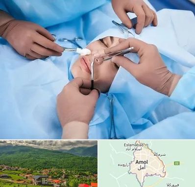 عمل بینی فانتزی در آمل