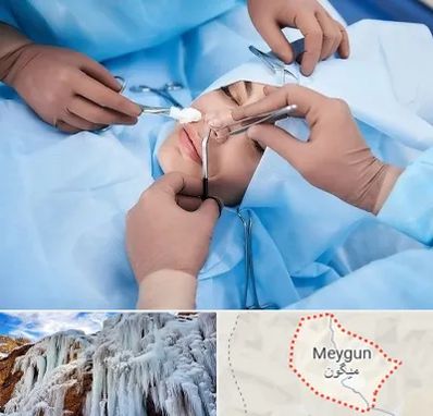 عمل بینی فانتزی در میگون