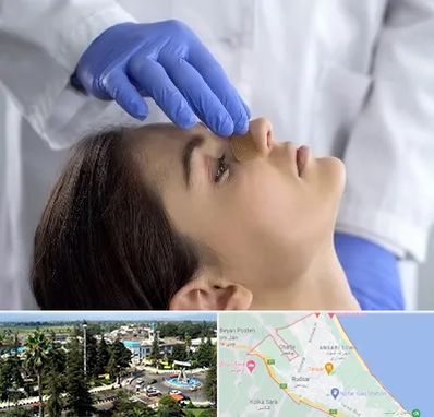 عمل بینی عروسکی در رودسر