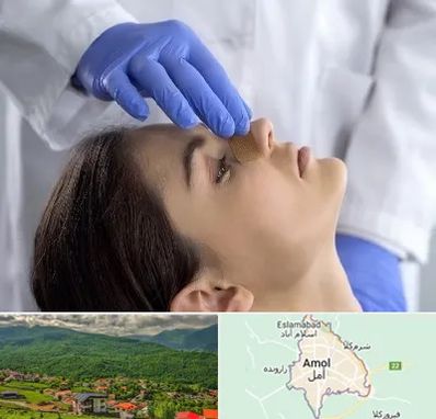 عمل بینی عروسکی در آمل