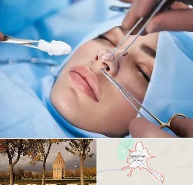 عمل ترمیمی بینی در تویسرکان