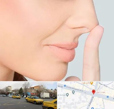 عمل تیپ پلاستی بینی در شهناز تبریز