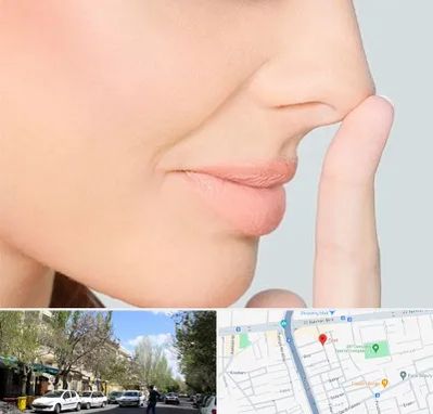 عمل تیپ پلاستی بینی در کوی فیروز تبریز